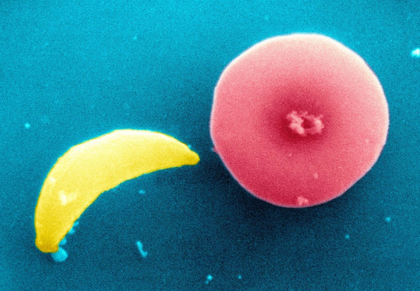 Parasite found in undercooked meat linked with risk of rare brain cancer